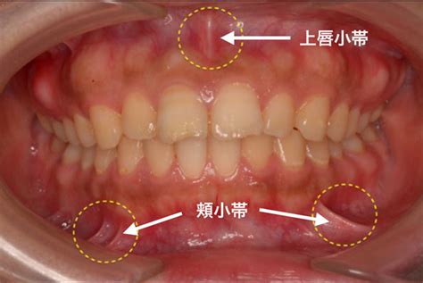 陰茎小帯|小帯切除術 – メンズ形成外科 